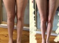 Фотография: Тейпирование